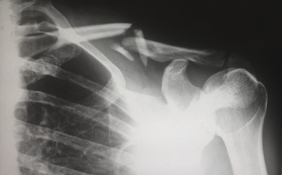 A broken shoulder bone shown on an x-ray. 